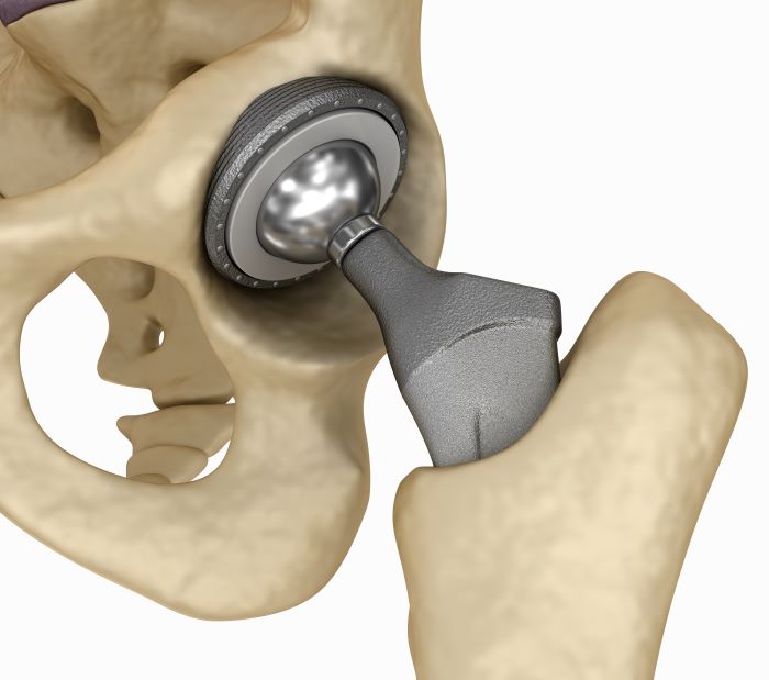 The Evolution of Total Hip Replacement