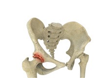 Hip Arthritis