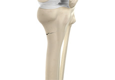Knee Fractures