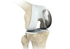 Partial Knee Replacement
